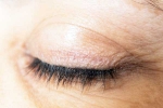Eyelash Dandruff health, Eyelash Dandruff treatment, all about eyelash dandruff, Dry skin
