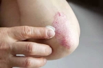 Skin disorders articles, Skin disorders health problems, five common skin disorders and their symptoms, Immune system