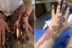 hand burnt due to henna tattoo, how to get rid of black henna scars, henna tattoo cause aussie woman to almost lose her hand, Tattoos hand burnt due to henna tattoo, how to get rid of black henna scars, henna tattoo cause aussie woman to almost lose her hand, Tattoos