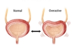 Overactive Bladder latest, Overactive Bladder disadvantages, here are some warning signs of an overactive bladder, Bsu