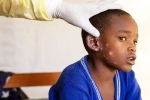 Mpox, Monkeypox Outbreak India, is monkeypox outbreak coming to india, Sweden