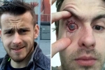 parasites eat man’s eye, can you take a bath with contacts in, contact lens wearers beware man goes blind after parasites eat man s eye as he wore lenses in shower, Sleepless nights