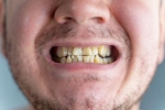 Nicotine stains latest breaking, Nicotine stains, are nicotine stains on your teeth irreversible, Toothpaste