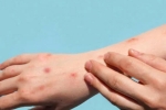 Monkeypox symptoms, Monkeypox updates, study says that the symptoms of monkeypox are different from earlier, Tedros adhanom ghebreyesus