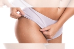 stretch marks causes, white stretch marks before and after, difference between red and white stretch marks explained and it s natural to have them, Stretch marks stretch marks causes, white stretch marks before and after, difference between red and white stretch marks explained and it s natural to have them, Stretch marks